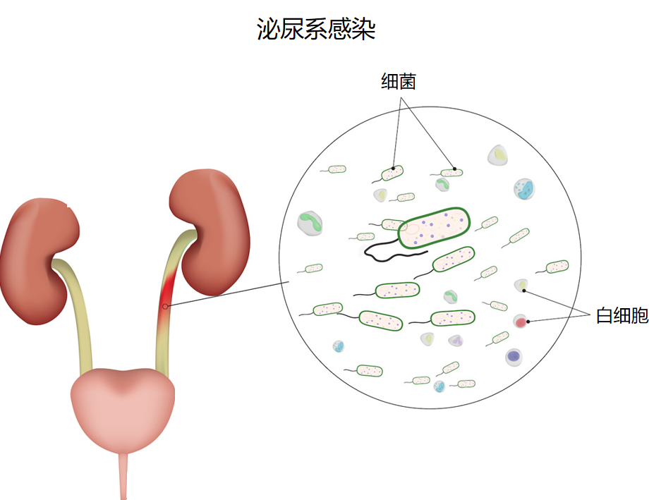 三伏天尿路結(jié)石的“高發(fā)季”，有哪些常見誤區(qū)