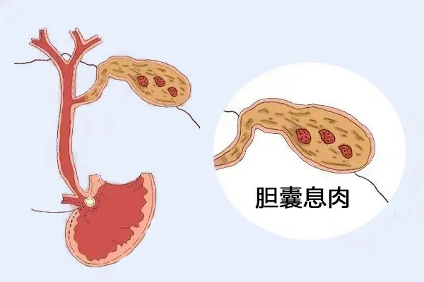 體檢出膽囊息肉，需要擔心嗎？