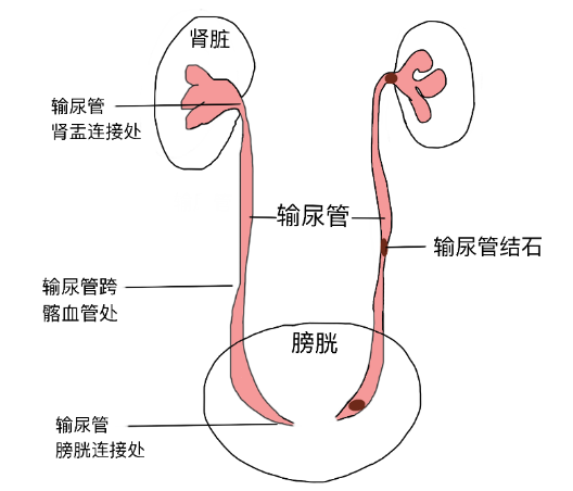 結(jié)石引發(fā)劇烈腎絞痛，該怎么辦？