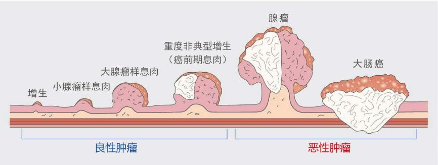 什么樣的腸息肉容易癌變？有一種要特別當心！