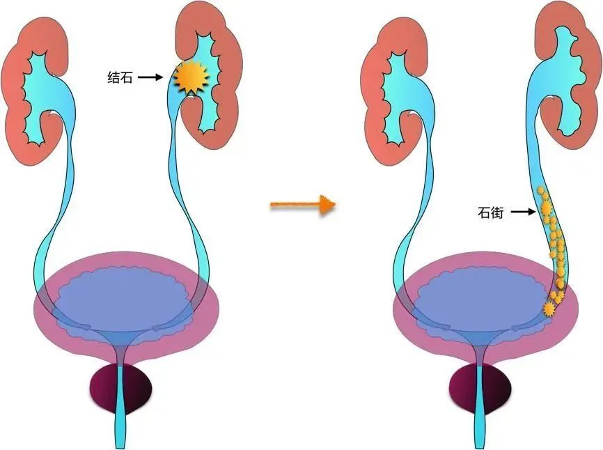 你經(jīng)歷過腎絞痛嗎？該如何緩解治療？